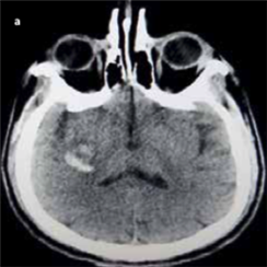 Microscopic Polyangiitis Nodosa: A Rare Cause of Cerebral Hemorrhage