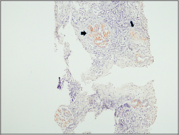 Patient with Renal AA Amyloidosis Following Pulmonary Squamous Cell Carcinoma: A Case Report and Literature Review