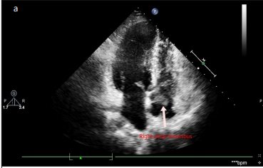 Incidental Right Atrial Thrombus in an 18-Year-Old Female Patient