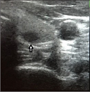 Evaluation of the Parathyroid Gland using Ultrasound Elastography in Children with Mineral Bone Disorder Due to Chronic Kidney Disease