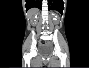 Life-Threatening Hypokalemia Presenting with Paralysis after Percutaneous Nephrolithotomy in a Patient with Nephrolithiasis: A Case Report
